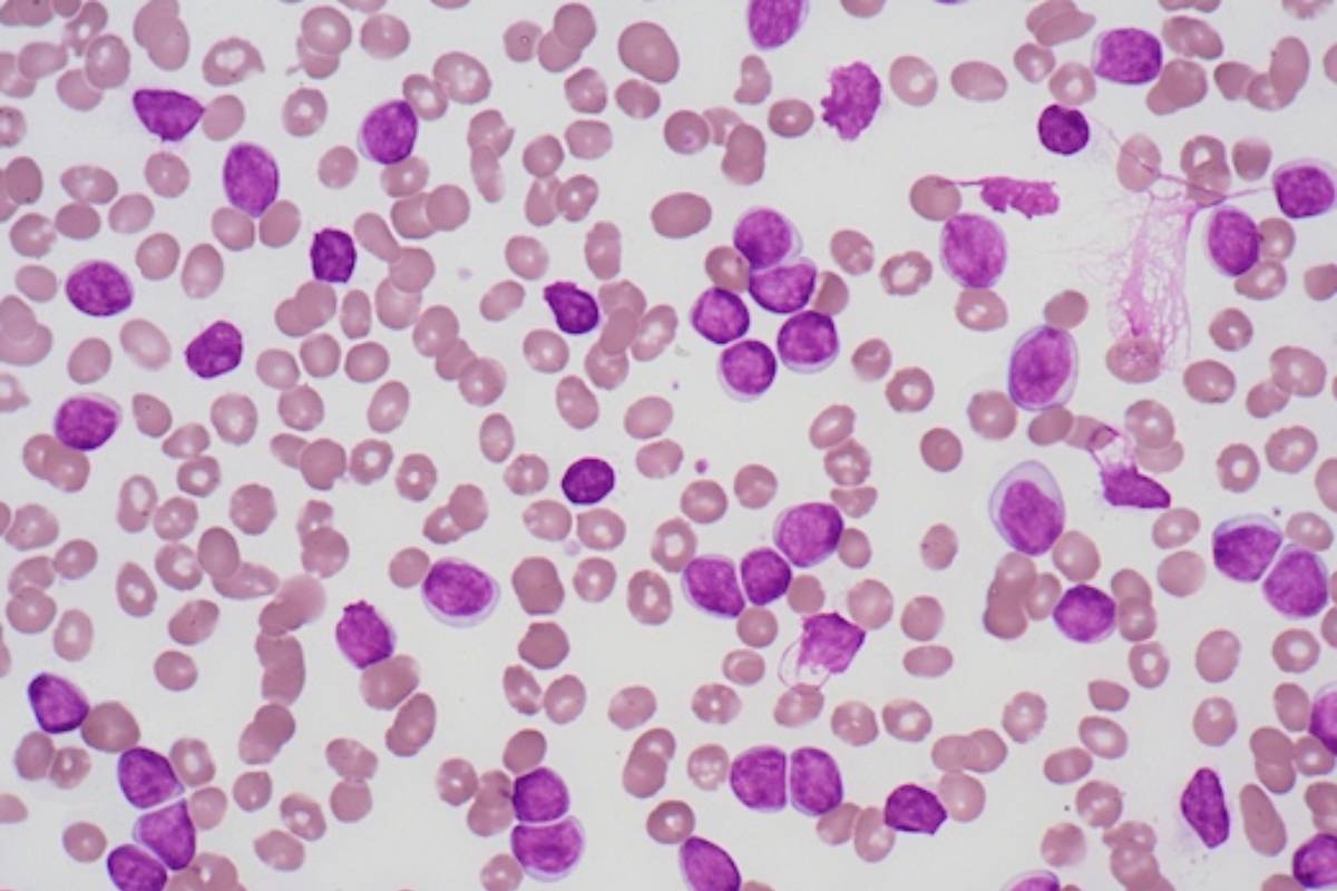 Imagen histológica de leucemia linfática crónica. 