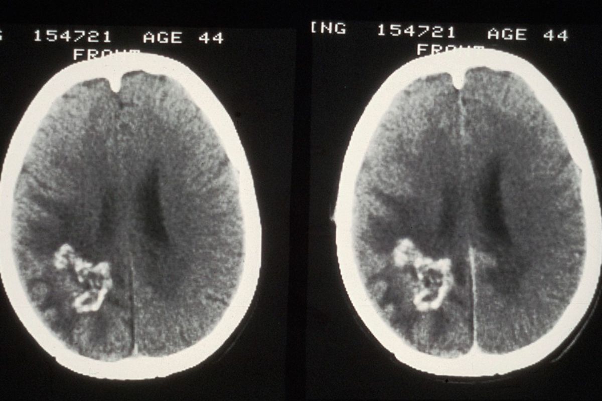Los tumores cerebrales de alto grado en niños tienen escasa respuesta a terapias convencionales/FOTO: DM. 