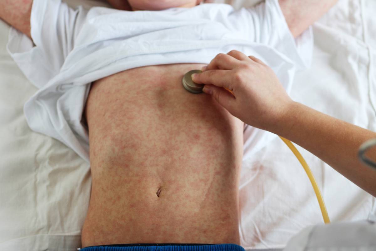El estudio recomienda valorar nuevas estrategias de vacunación contra el sarampión a medio y largo plazo 