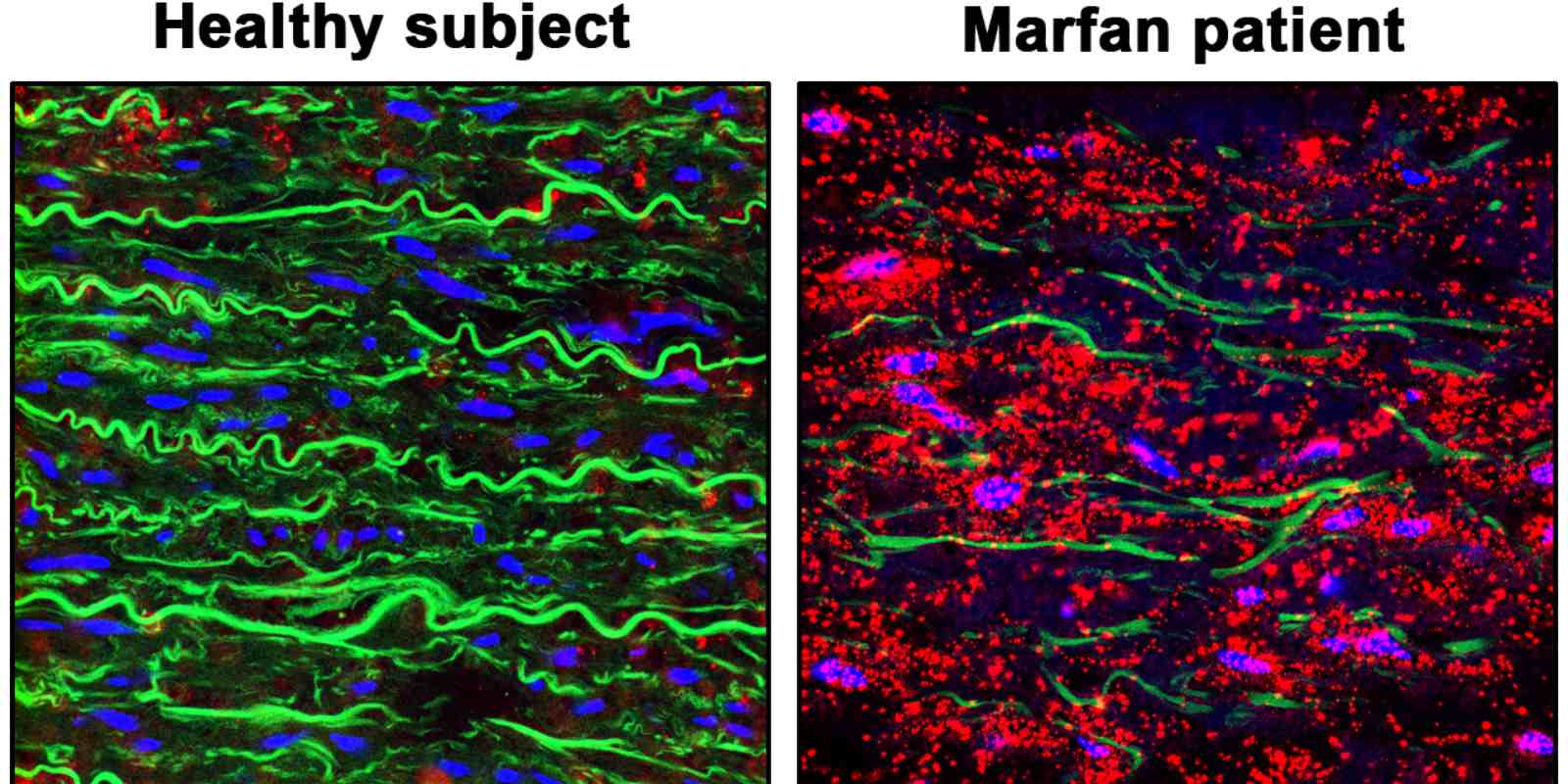 : Imágenes de la aorta de un individuo sano y de un paciente de síndrome de Marfan mostrando la desintegración de las fibras elásticas (en verde) y la sobre-activación de la proteína PRKG (puntos rojos).