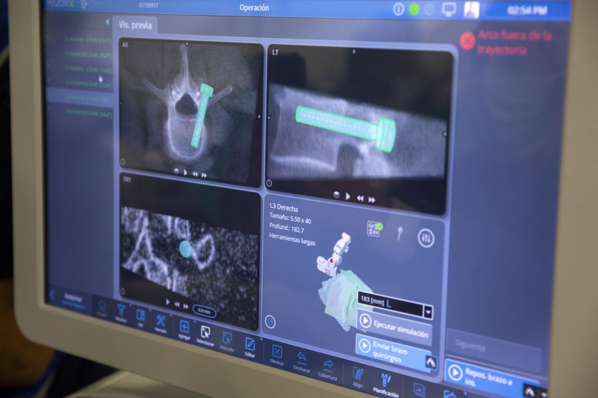Las imágenes que ofrece el nuevo robot quirúrgico para columna son de una elevada precisión. FOTO: Hospital Quirónsalud Barcelona. 