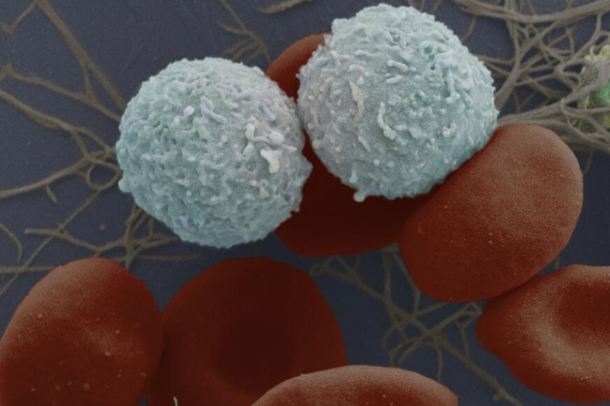 La leucemia linfoblástica aguda se caracteriza por la proliferación de blastos de estirpe linfoide. 