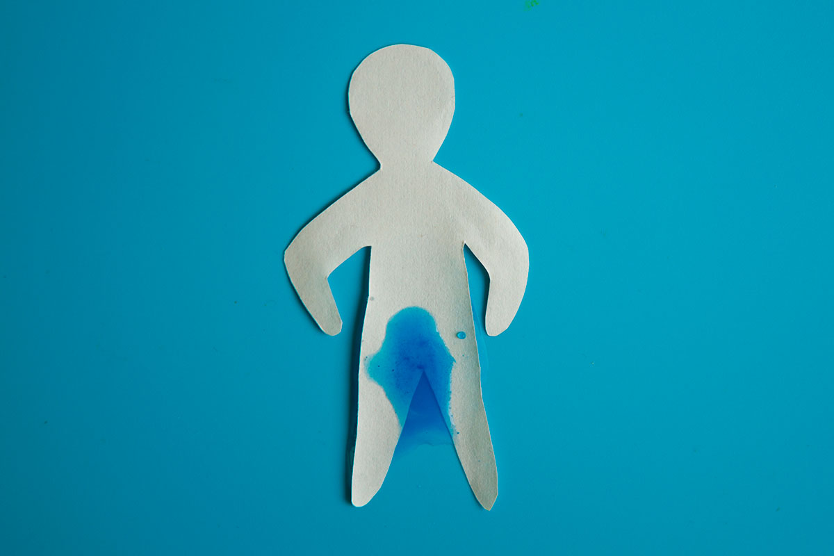Se calcula que entre el 10-15% de los varones que han sido intervenidos por patología prostática, sobre todo cáncer de próstata, necesitan un tratamiento para la incontinencia urinaria.