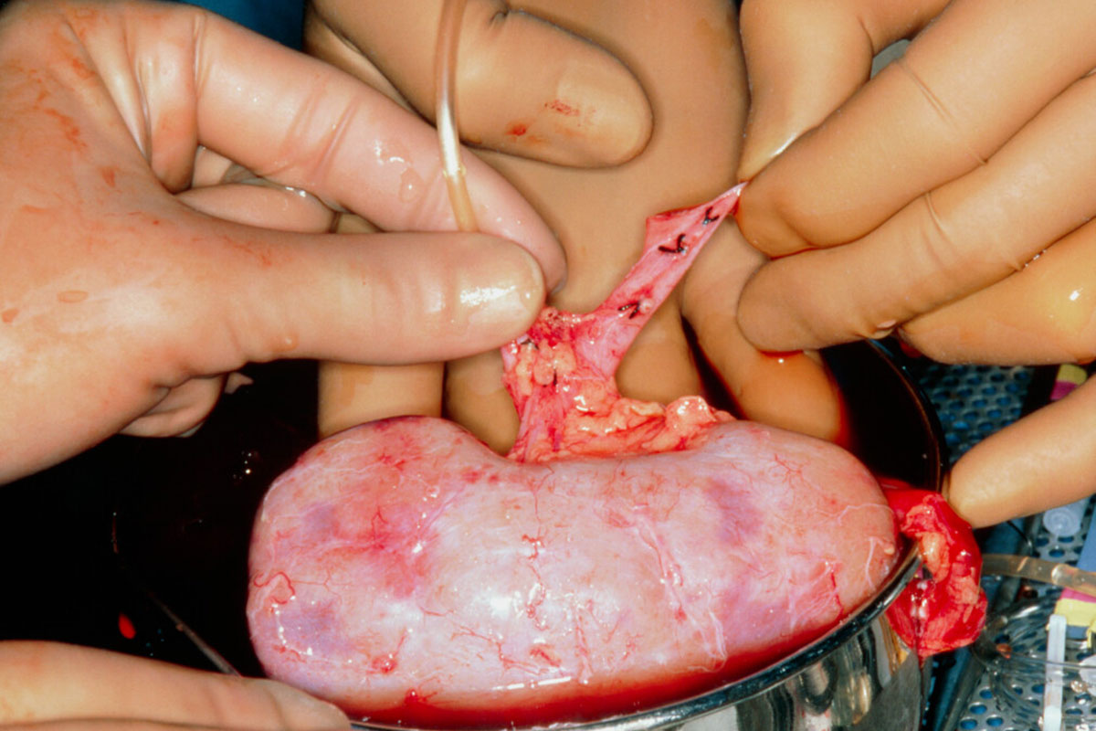 Trasplante de riñón (FOTO: Stockphotos). 