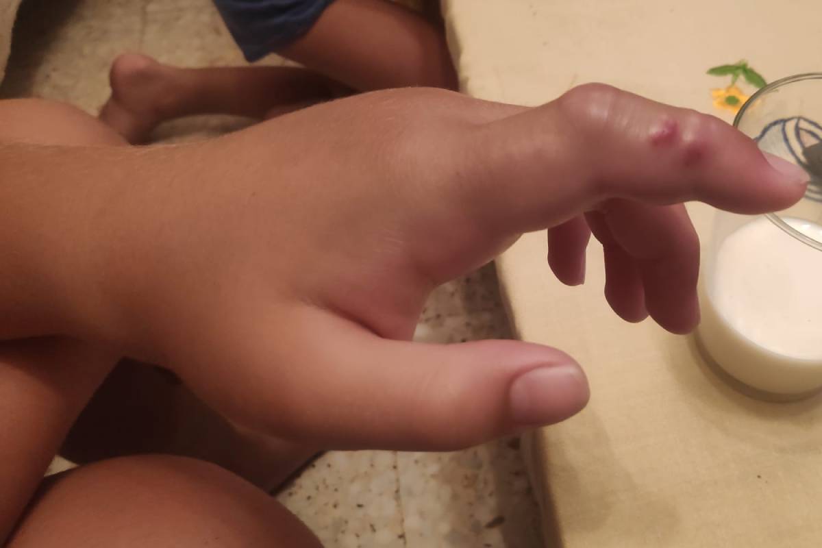 Mordedura de víbora en la mano de un niño, producida en la sierra de Gredos (Ávila) a finales de julio de 2021.