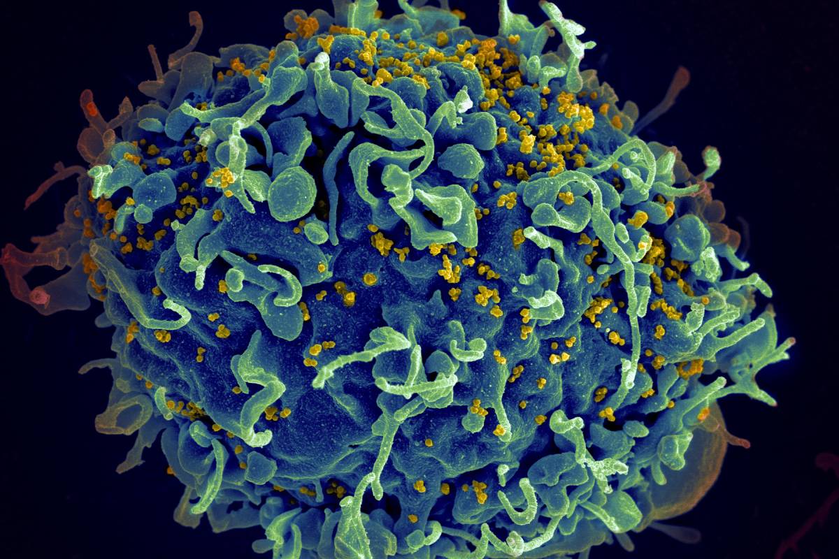 CÃ©lula humana (linfocito T, azul) atacada por el virus VIH (amarillo). | NIH.
