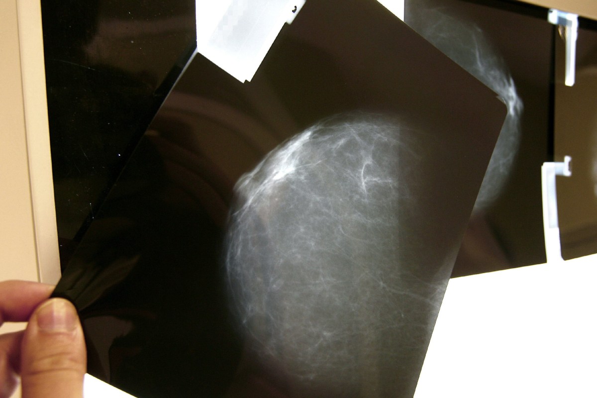 Radiografía de un cáncer de mama. 