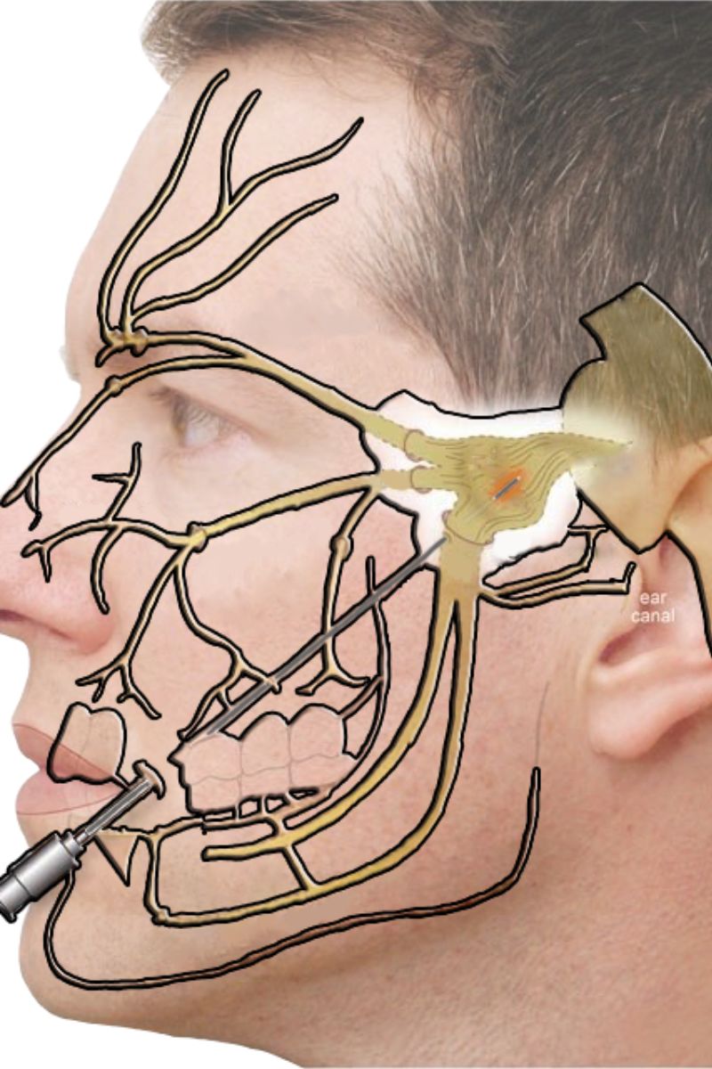 Distintas zonas de afectación de la neuralgia del trigémino. FOTO: Instituto Clavel. 