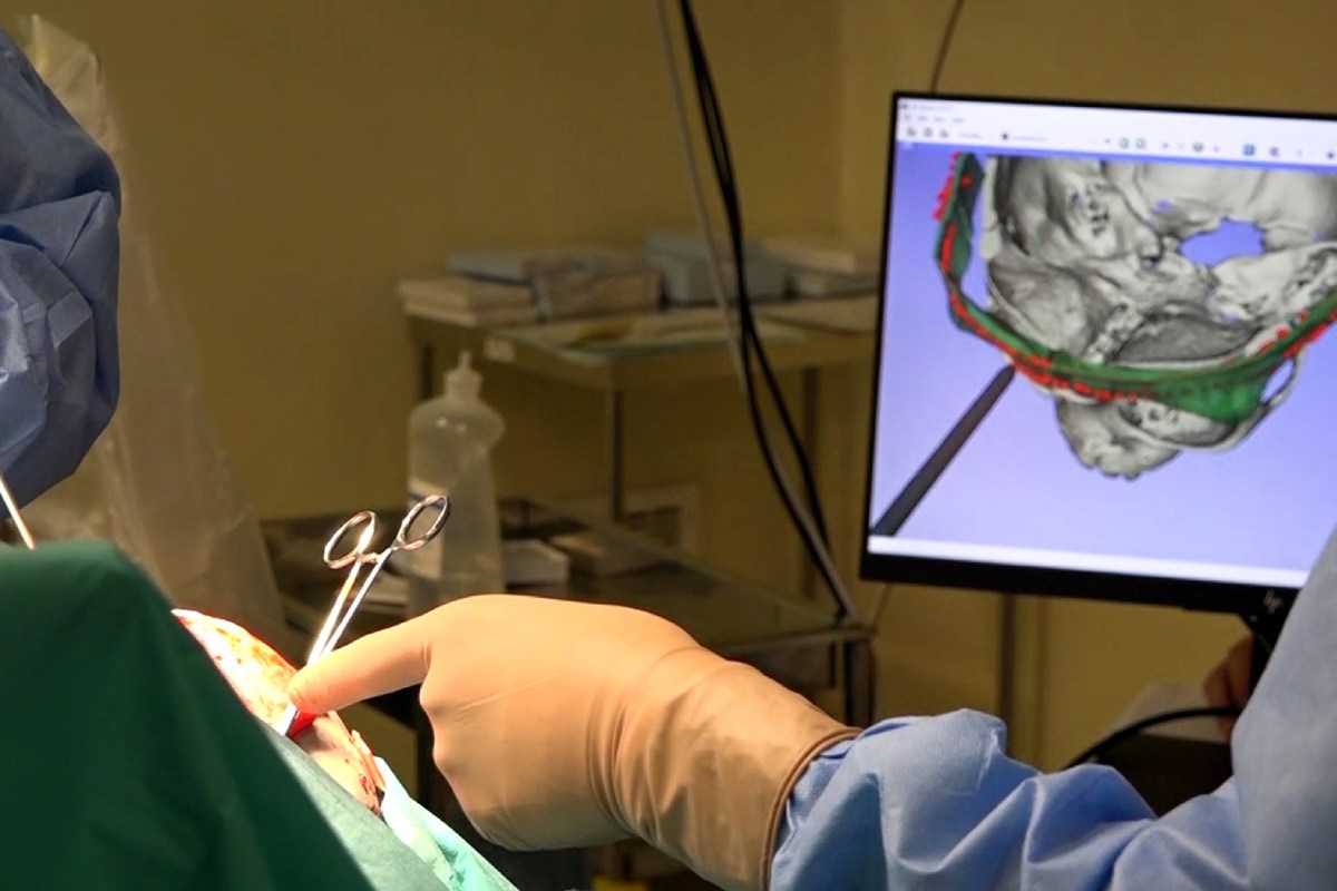 La intervenciÃ³n es guiada por navegaciÃ³n intraoperatoria.