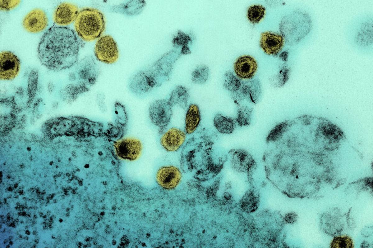 El virus HTLV-1 es un agente etiológico de la leucemia-linfoma de células T, una rara enfermedad hematológica, pero muy agresiva. 