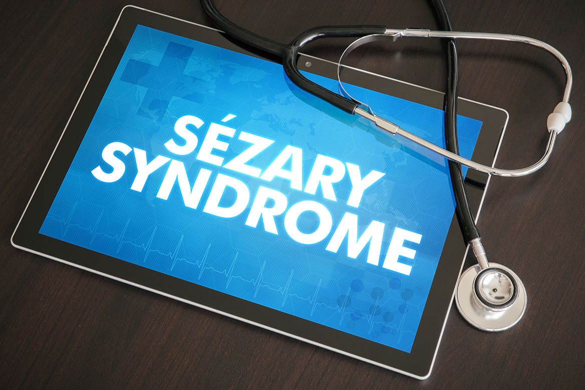 Síndrome de Sézary: diagnóstico precoz, tratamiento multidisciplinar e investigación para avanzar en esta enfermedad 