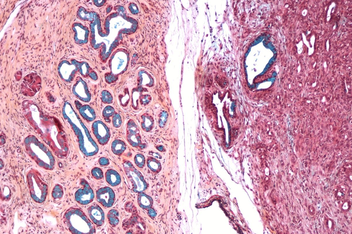 Las células del cáncer de páncreas podr�an modificarse mediante la introducción de la toxina del tétanos. FOTO: DM. 