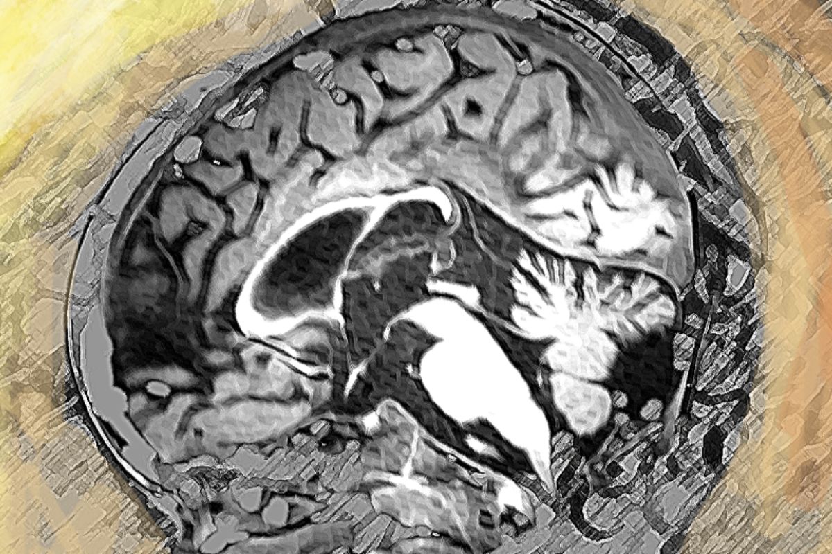 Imagen de cerebro con alteraciones de la mielina. FOTO: Idibell. 