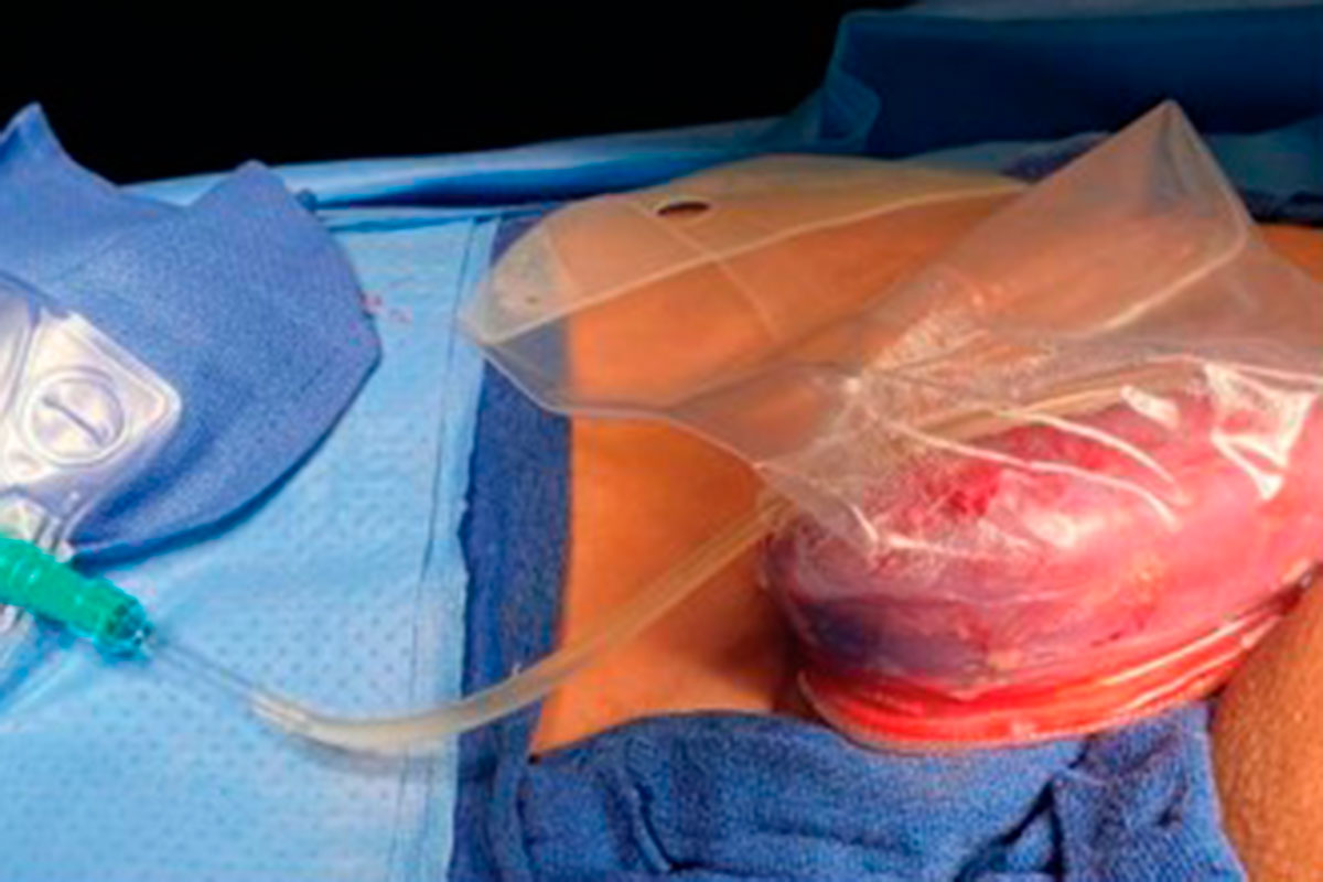 La imagen muestra cómo se configura la conexión del uréter con el drenaje para aislar la orina obtenida del 