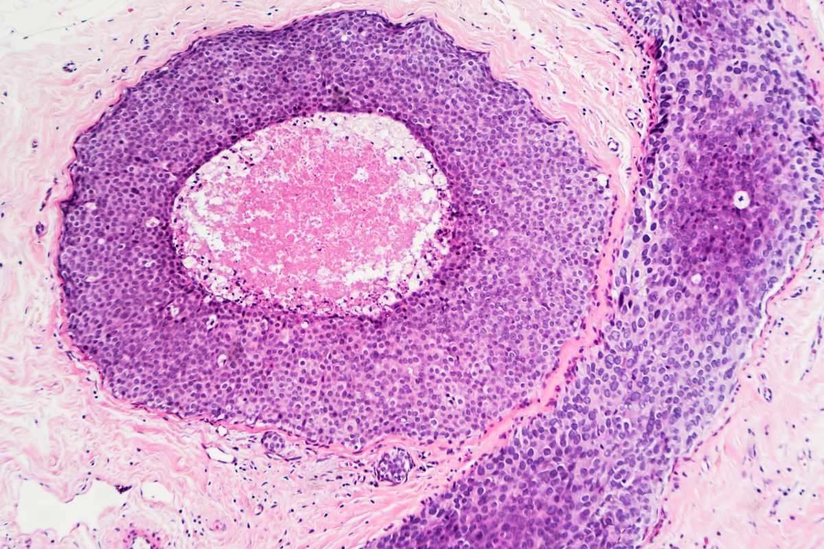 El sistema del IRB Barceloan está pensado para todo tipo de tumores, entre ellos los de mama (en la imagen, un carcinoma ductal in situ).