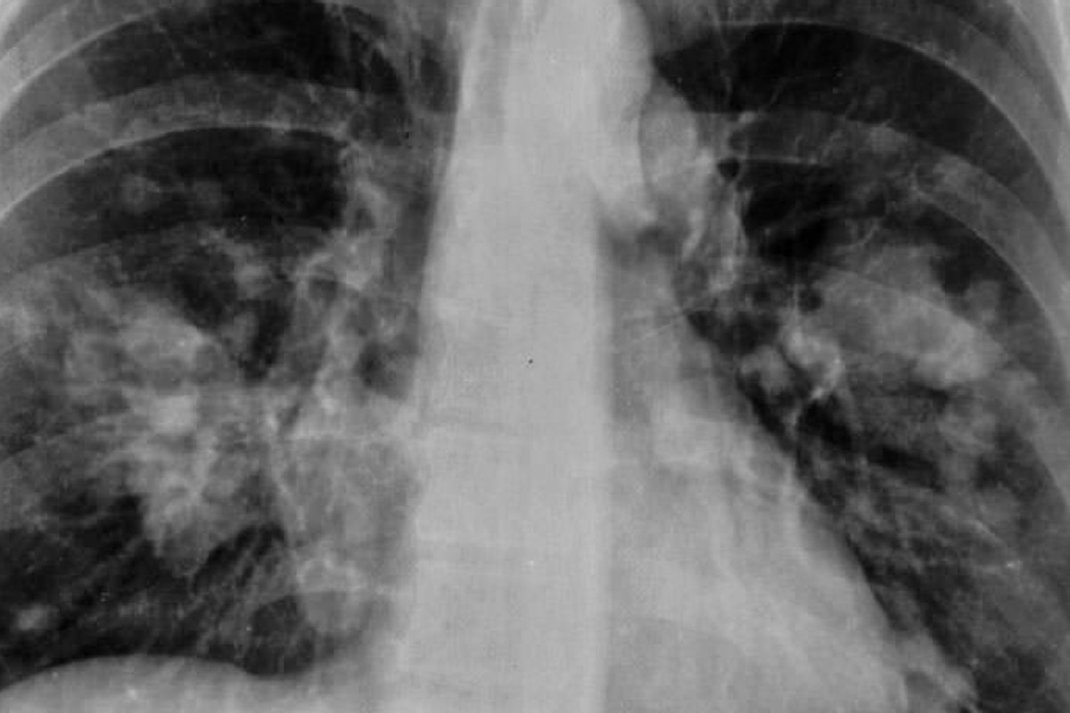 Según cifras de la Sociedad Española de Oncología Médica, en 2022 se diagnosticarán en España unos 31.000 nuevos casos de cáncer de pulmón.