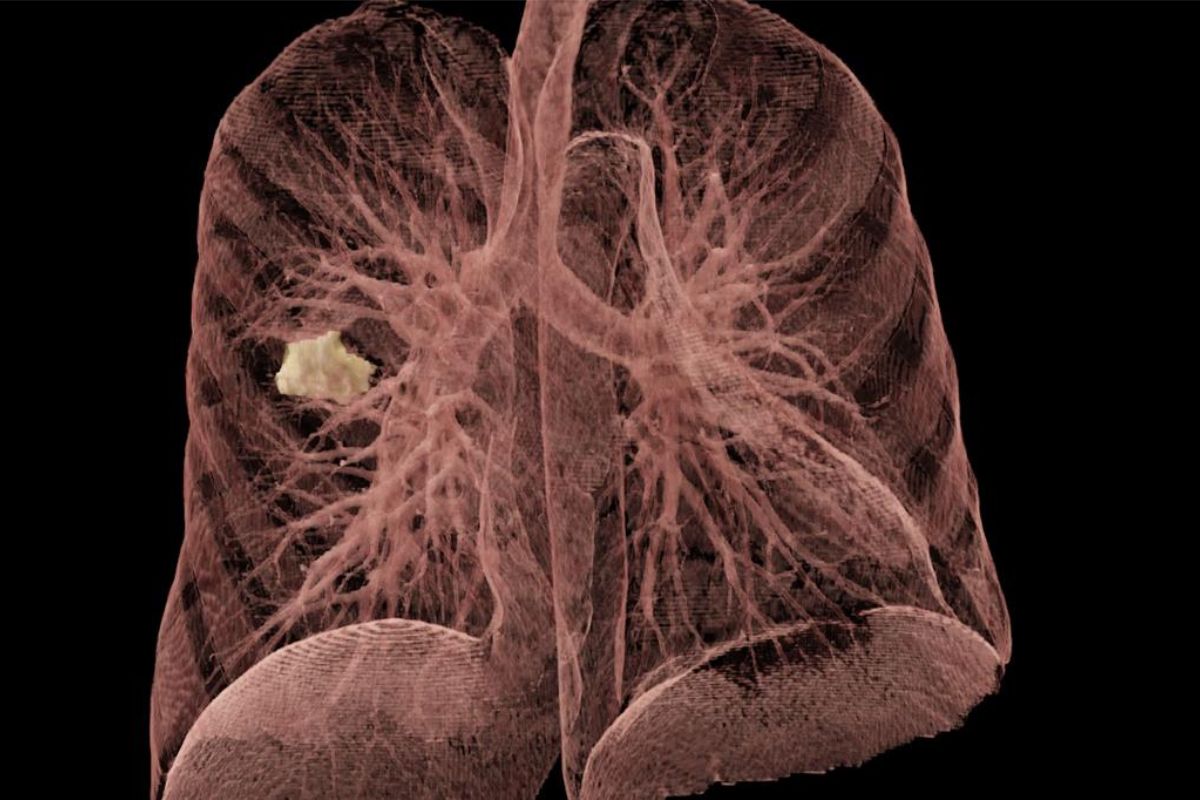 El cáncer de pulmón sigue siendo uno de los más mortales. Los considerados menos frecuentes también deben beneficiarse de las actuales estrategias. Foto: NYU LANGONE. 