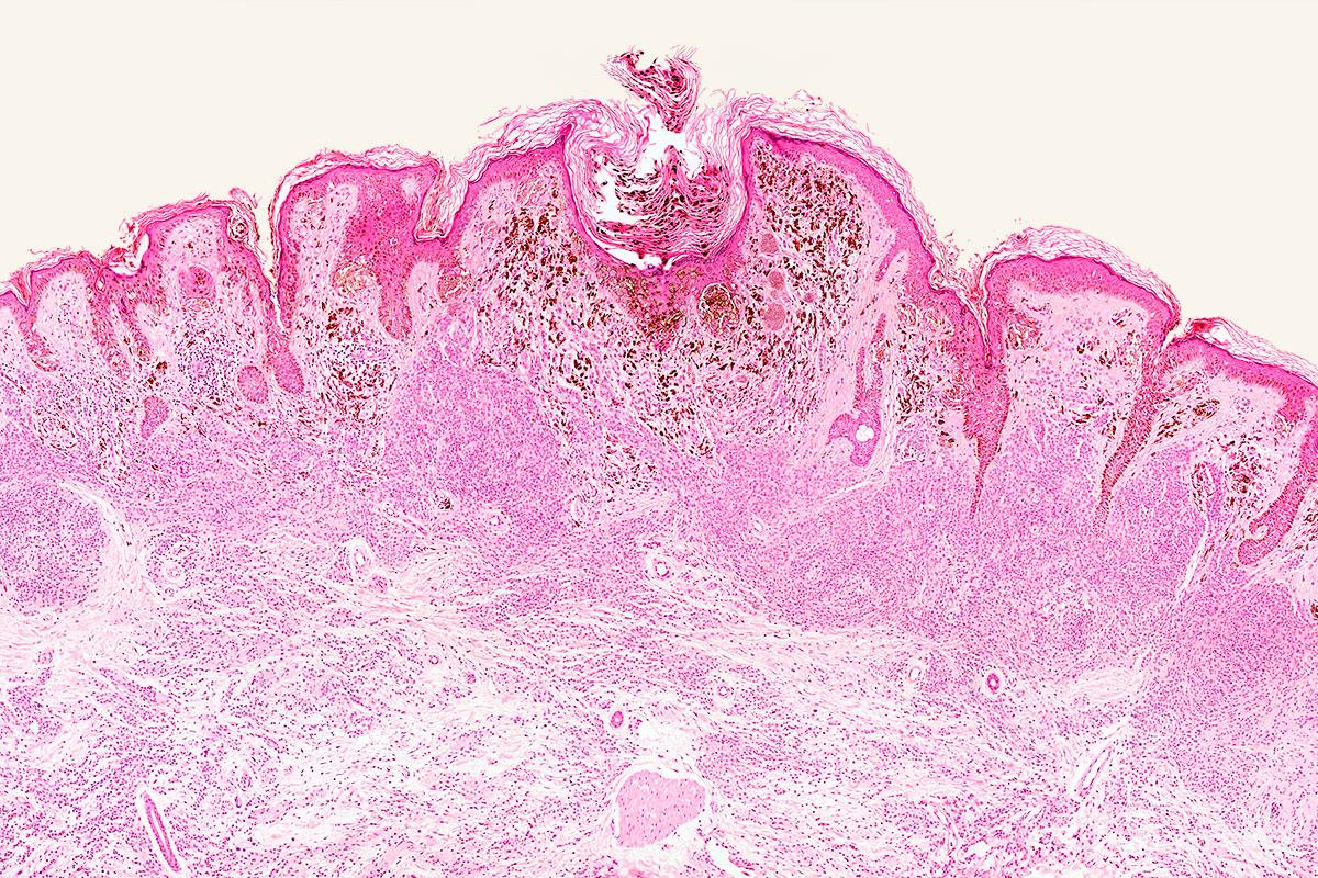 Imagen del microscopio de melanoma maligno. 