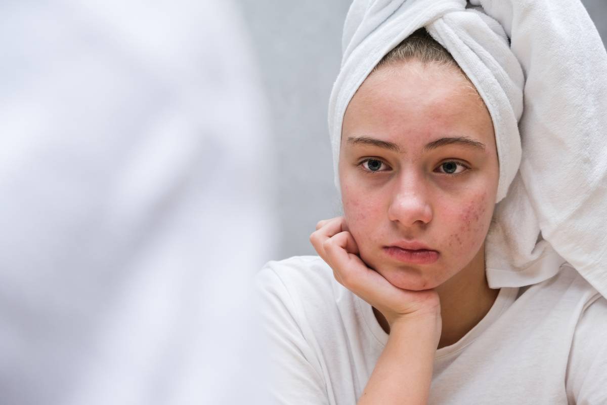 El acné es una afección de la piel que suele darse durante la pubertad. Foto: SHUTTERSTOCK 