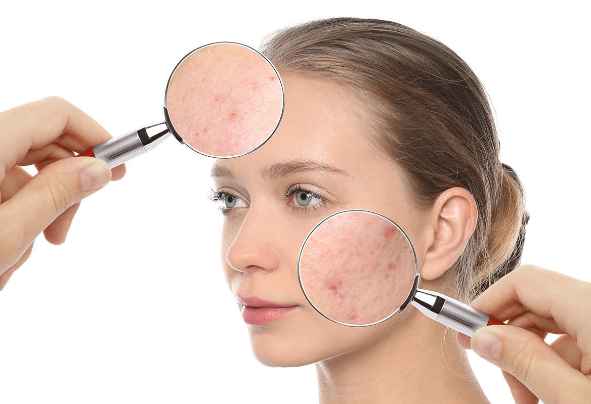 La importancia de los retinoides tópicos en el tratamiento del acné 