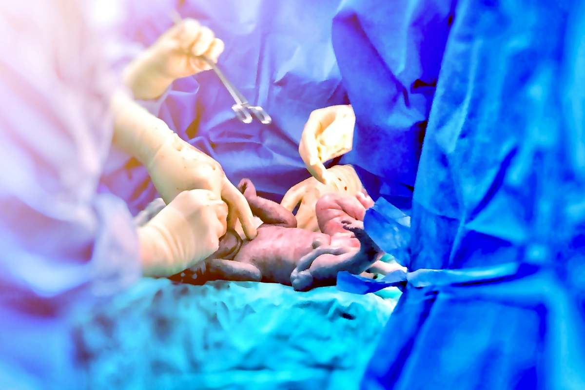 El acretismo placentario puede poner en riesgo la vida de la madre y del bebé. 