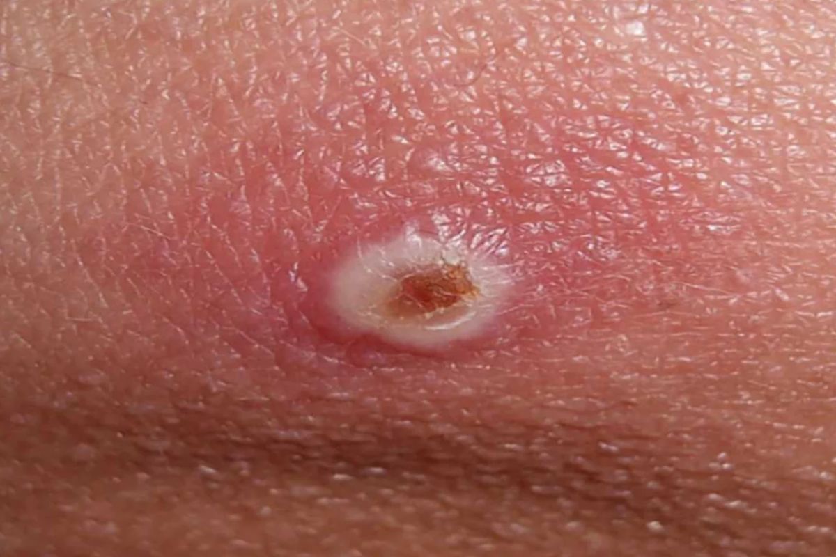 Las pápulas suelen aparecer tras los primeros síntomas de la infección. Foto: DM. 