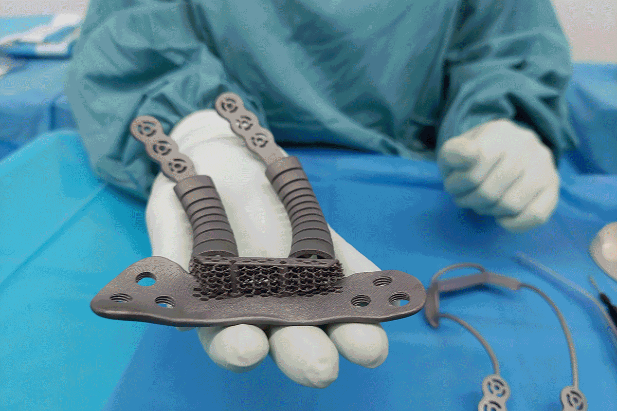 La nueva prótesis funcional es una alternativa a las rígidas que se usan convencionalmente. Foto: HOSPITAL DE SANT PAU 