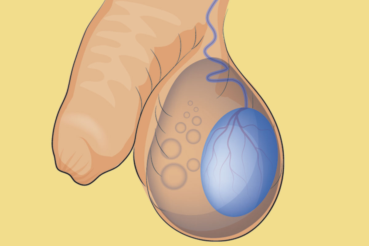 El hidrocele consiste en una acumulación de líquido circunscrita a la cavidad vaginal del testículo. 