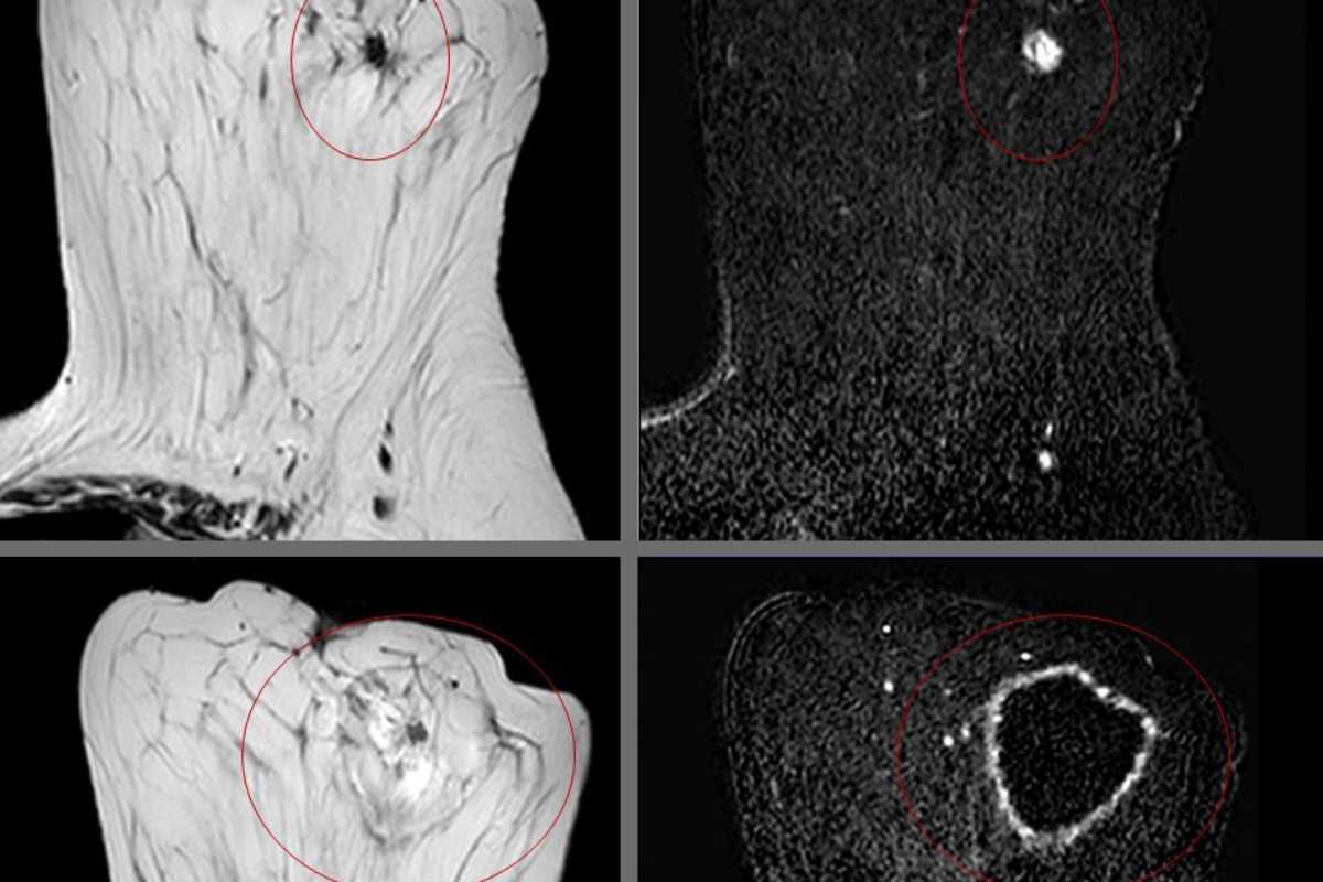 Visto con resonancia magnética, el tumor (arriba) y después de la ablación con radiofrecuencia (abajo). Imagen: HOSPITAL DE BELLVITGE. 