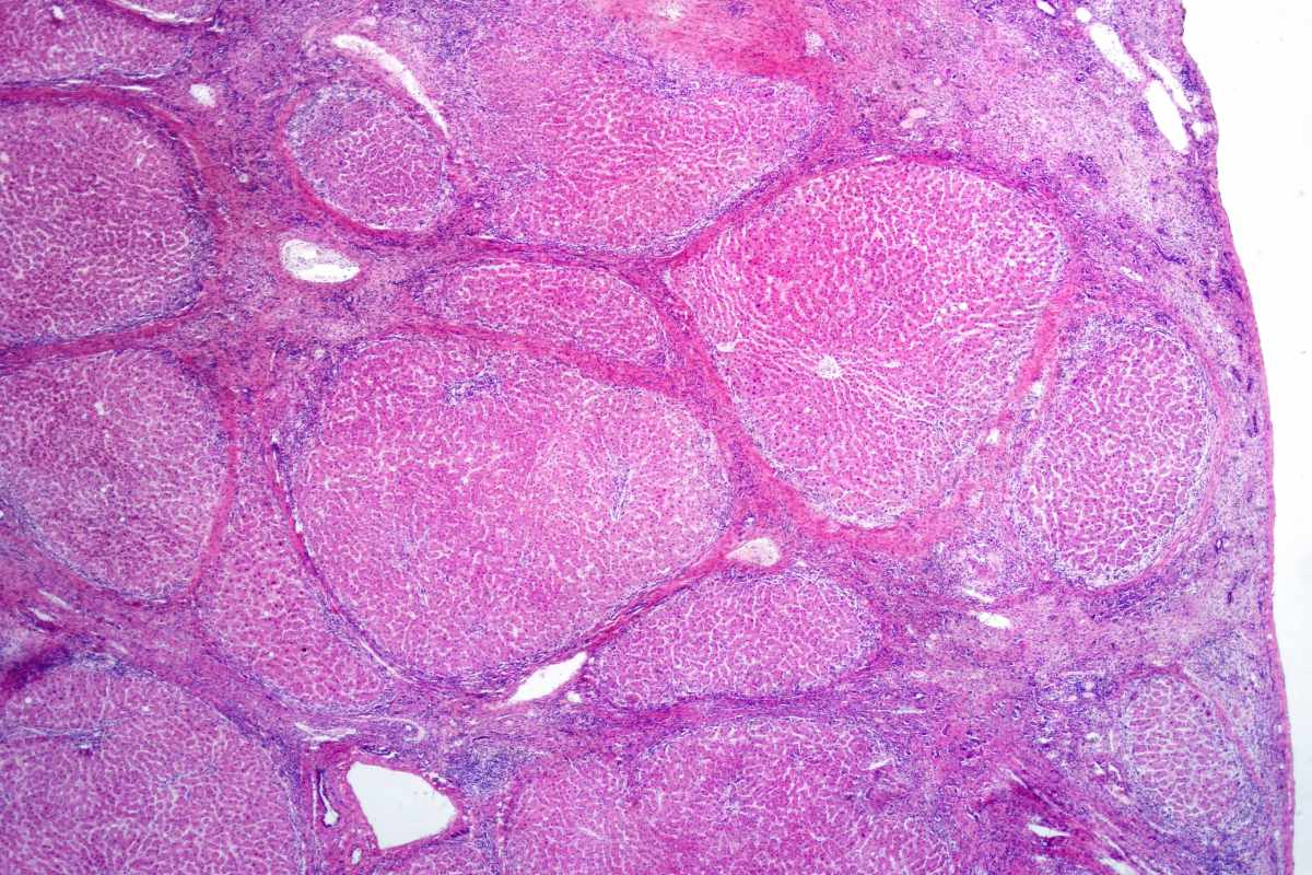 Muestra de tejido de un hígado humano con cirrosis. Foto: SHUTTERSTOCK 