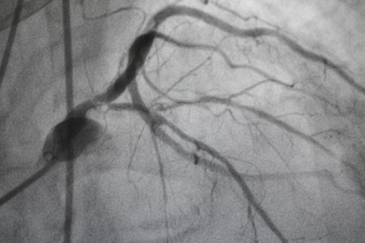 Angiografía coronaria. Foto: SHUTTERSTOCK. 
