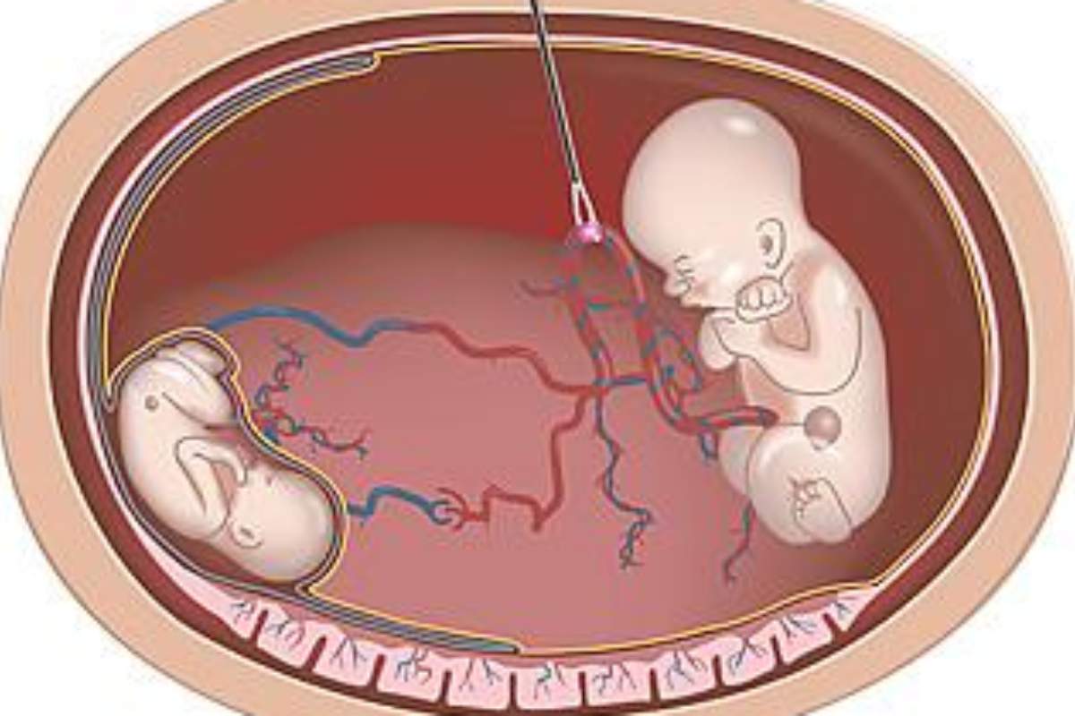 Detección ecográfica del Síndrome de transfusión feto-fetal por el que fallecieron las dos niñas en gestación. Foto: DM 