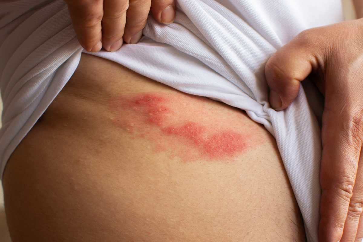 Los datos indican un aumento de casos de herpes zóster en menores de 50 años. Foto: SHUTTERSTOCK 