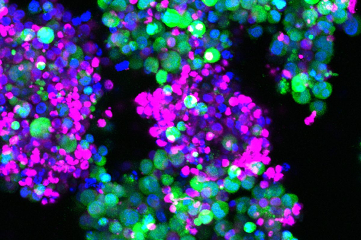Las células CAR-T (rosas) atacan a células de un cáncer hematológico (verde). A medida que las células tumorales mueren, se vuelven azules. Foto: INSTITUTO MALAGHAN. 