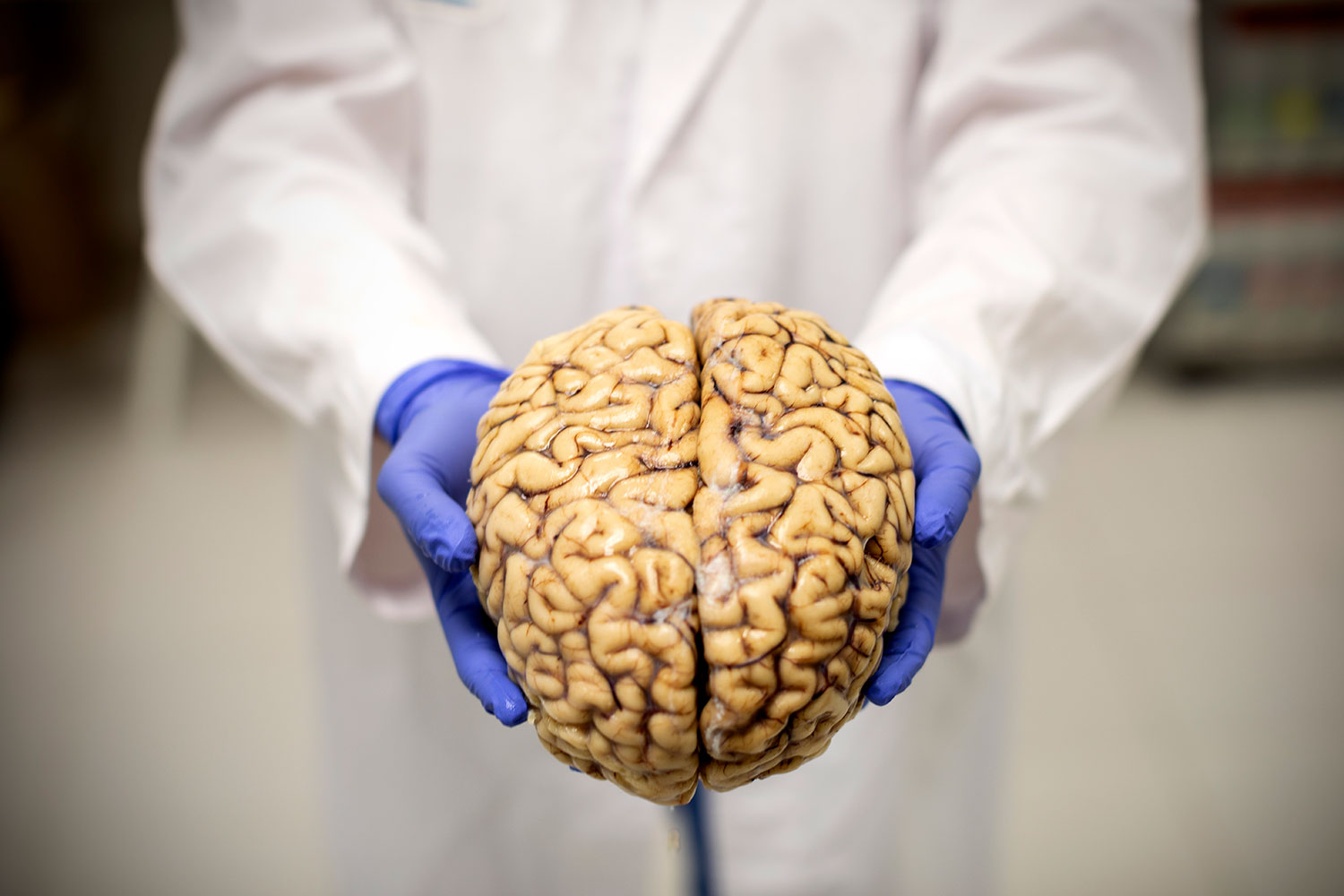 Un cerebro conservado en el Banco de Cerebros de la fundación del Centro de Investigación de Enfermedades Neurológicas del Hospital Reina Sofía. Foto: ALBERTO DI LOLLI. 