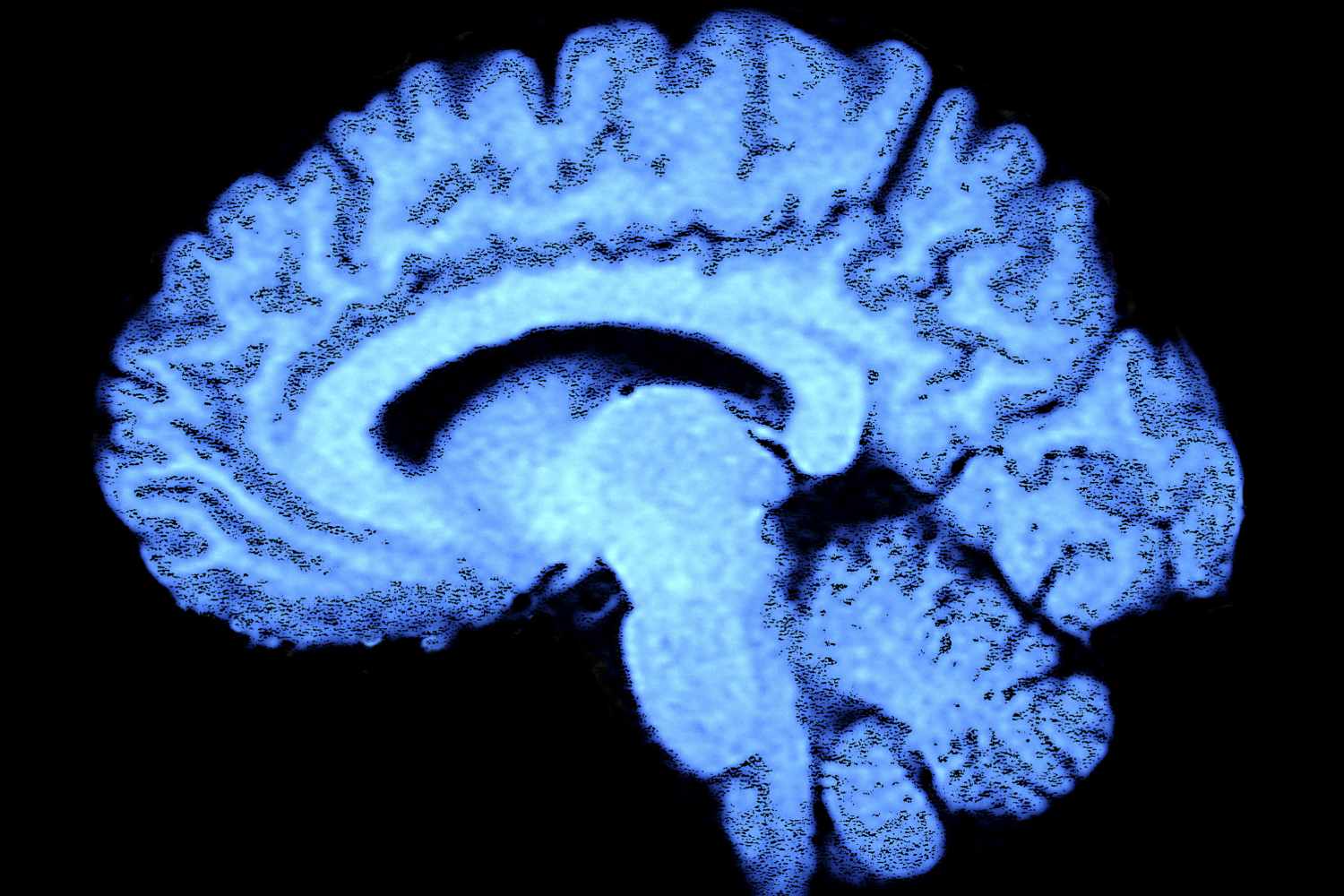 ELA y demencia fronto-temporal tienen características comunes. Foto: DIARIO MÉDICO. 