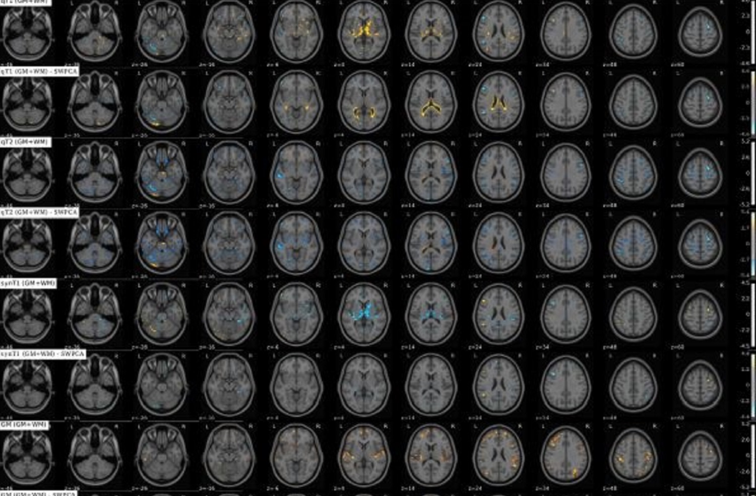Resonancias magnéticas (RM) cerebrales. Foto: DM 