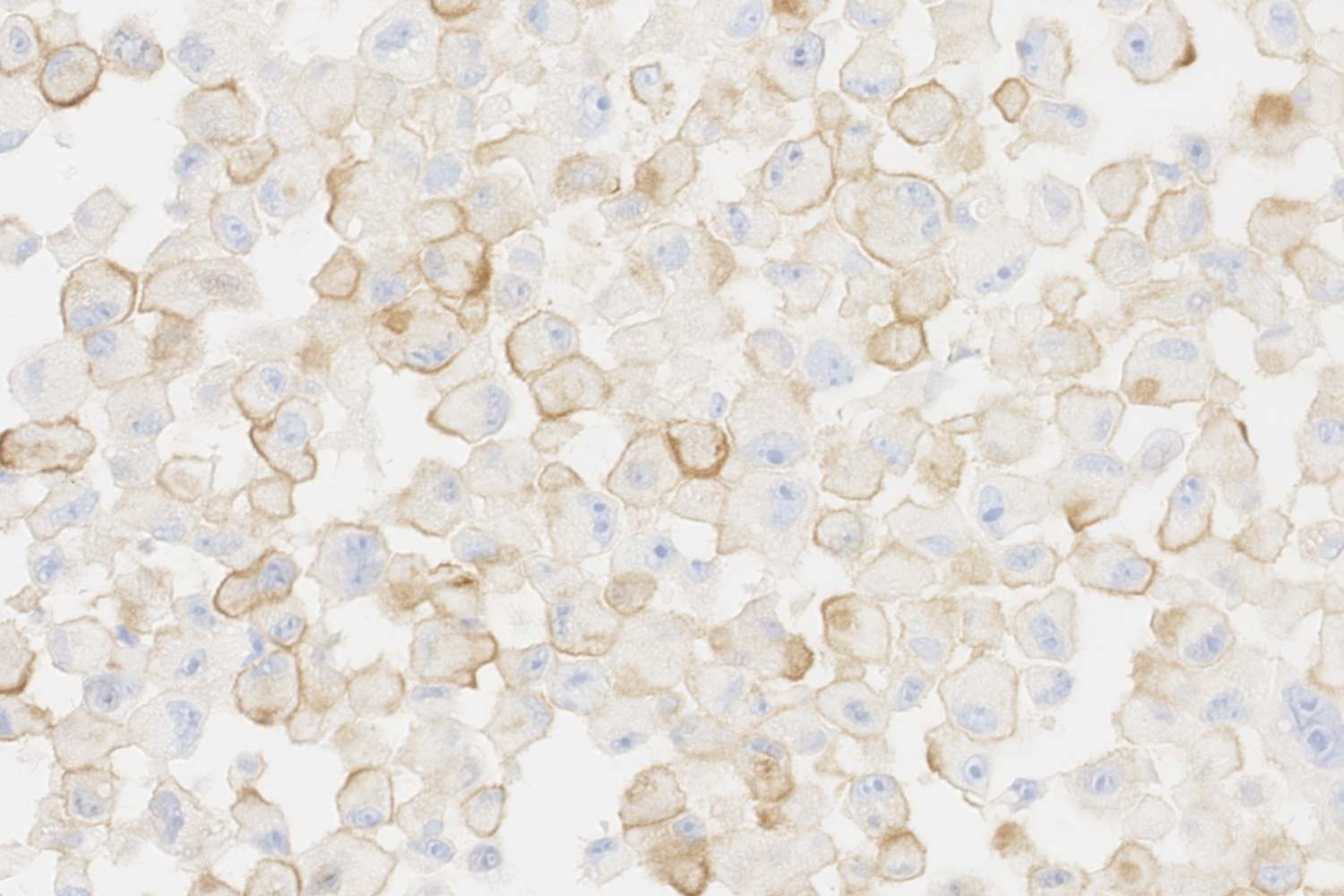 Células tumorales senescentes de melanoma humano. En marrón, la proteína PD-L2 que actúa de escudo protector y evita la acción del sistema inmune. Foto: IRB BARCELONA 