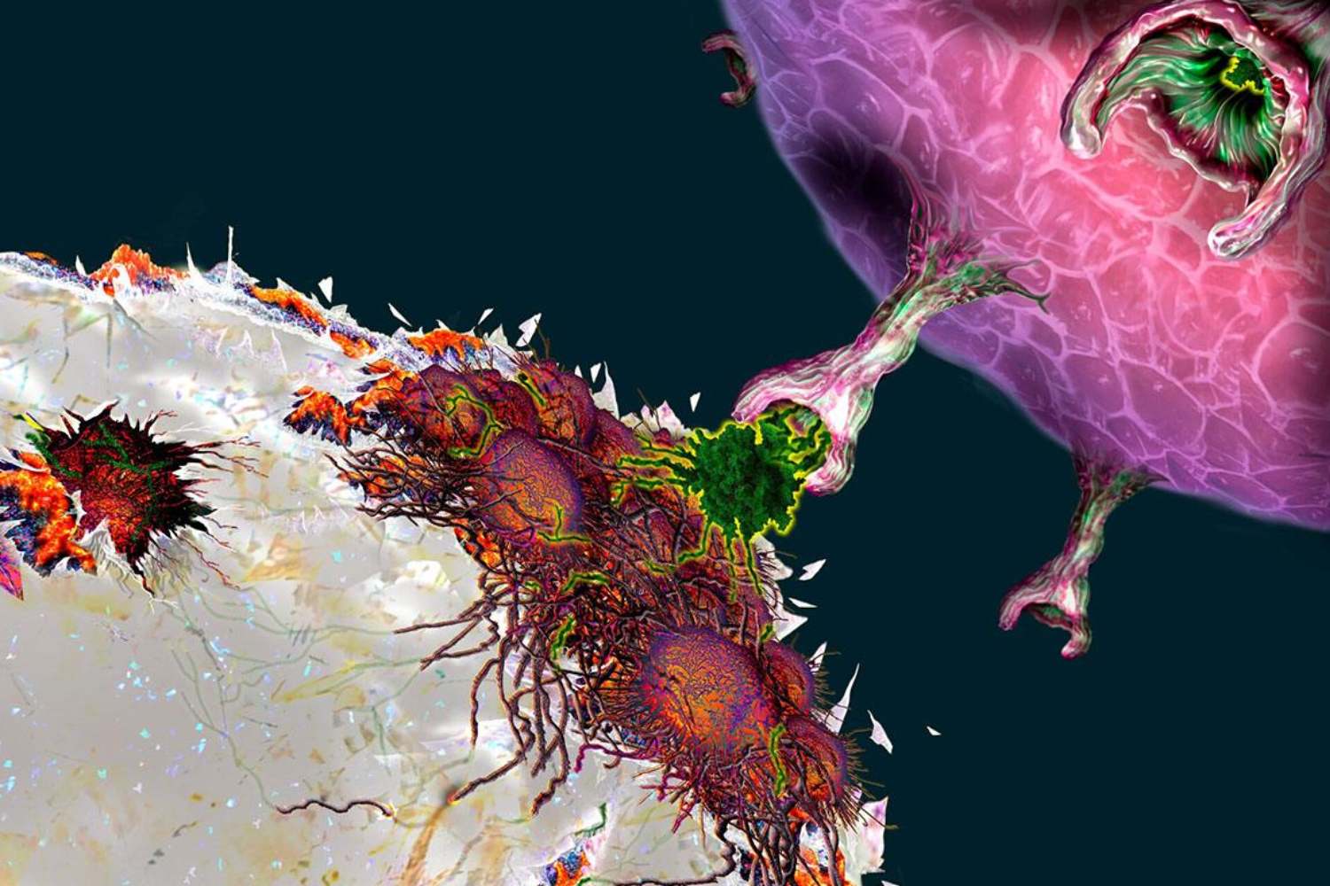 El receptor de antígeno quimérico (CAR) del linfocito T reconoce a la célula tumoral. 