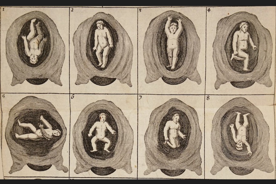 Posiciones del feto (de Mellificium chirurgiae, 1693). 