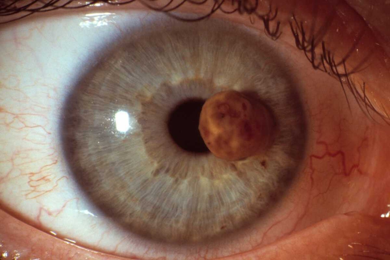 El uveal es una forma rara y agresiva de melanoma que se desarrolla a partir de las células malignas melanocíticas pigmentadas de la coroides, el iris o el cuerpo ciliar ocular. 