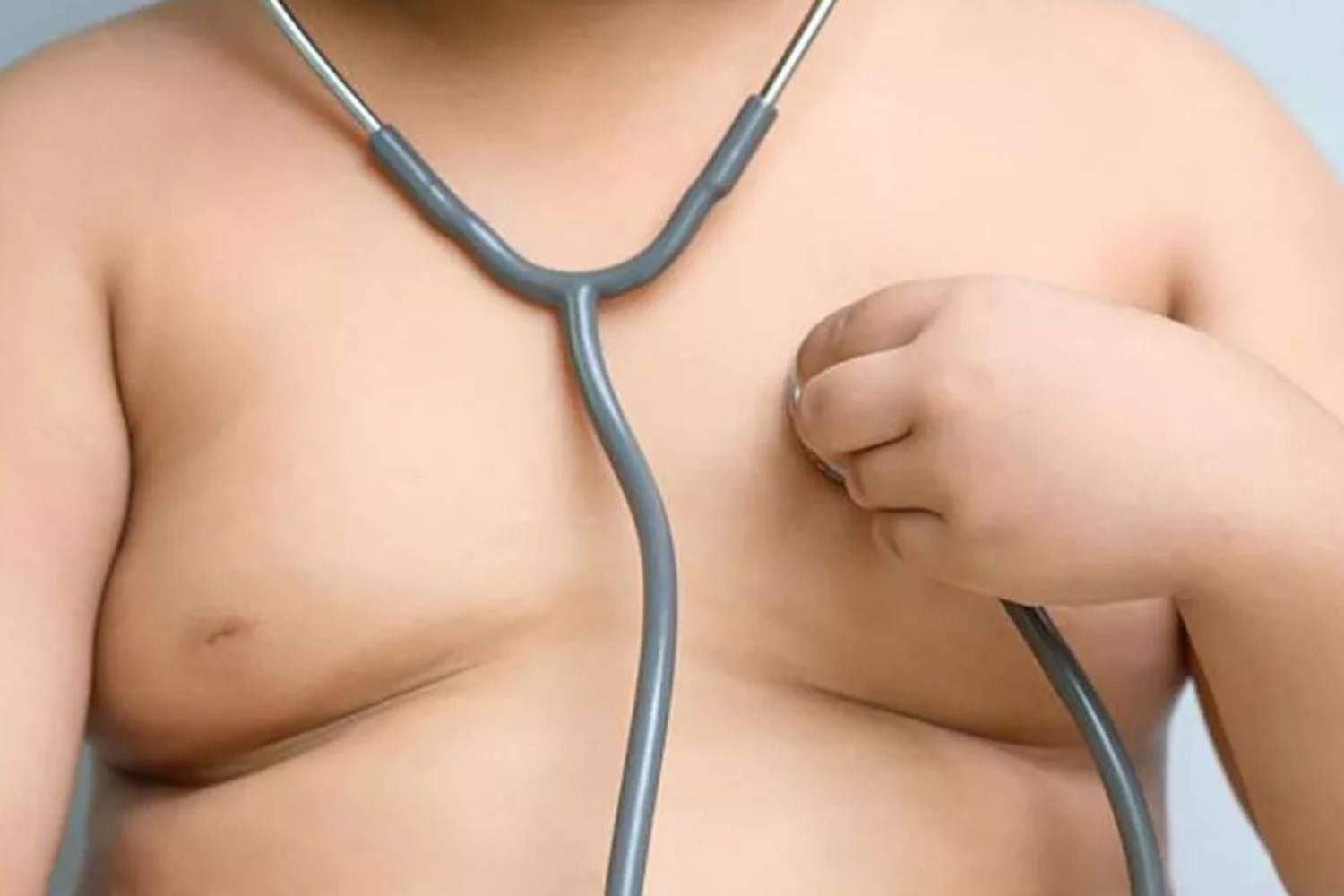 La semaglutida ha demostrado reducir la morbimortalidad cardiovascular en pacientes con sobrepeso y obesidad y ECV establecida. 