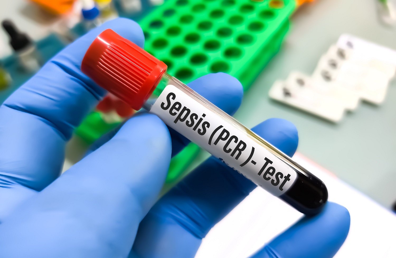 Combinar parámetros clínicos con PCR ayuda a mejorar el diagnóstico de la sepsis. Foto: SHUTTERSTOCK 