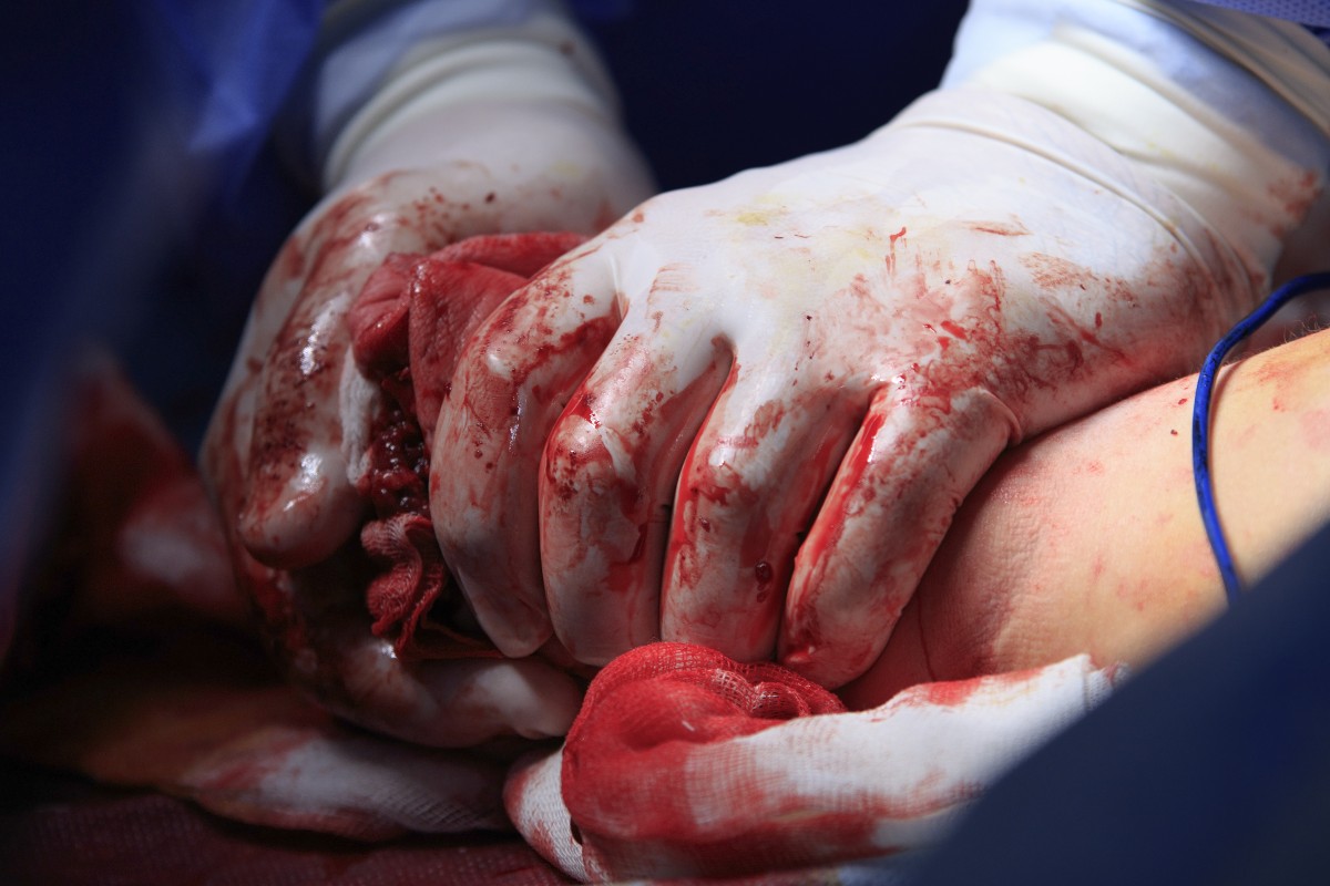 Cirujanos deteniendo una hemorragia en una intervención quirúrgica. Foto: SHUTTERSTOCK. 