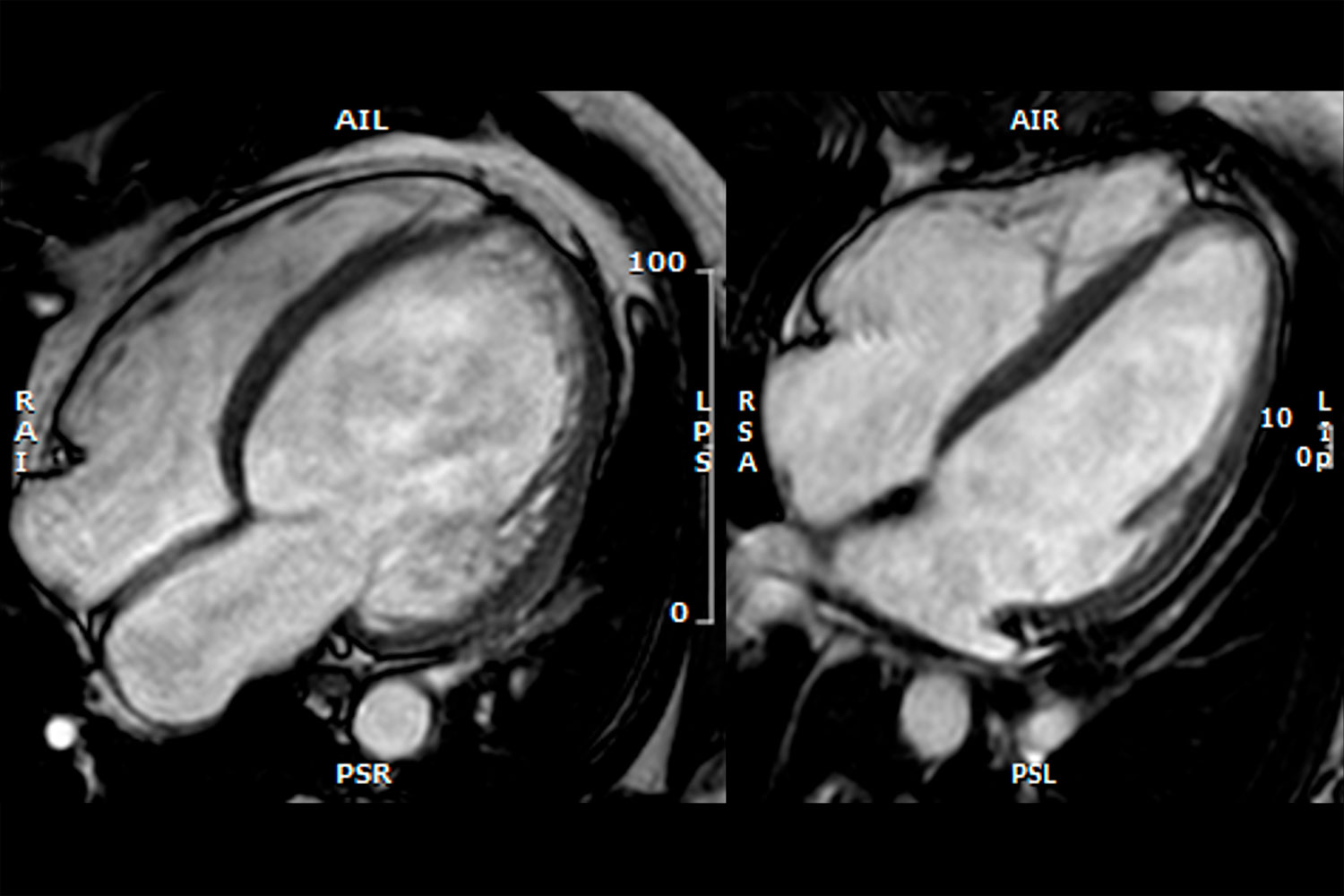 A la izqda., resonancia magnética de un paciente con miocardiopatía dilatada (el tamaño del corazón está incrementado y su capacidad de bombeo está disminuida) y a la dcha. de un individuo sin cardiopatía. Foto: CNIC. 