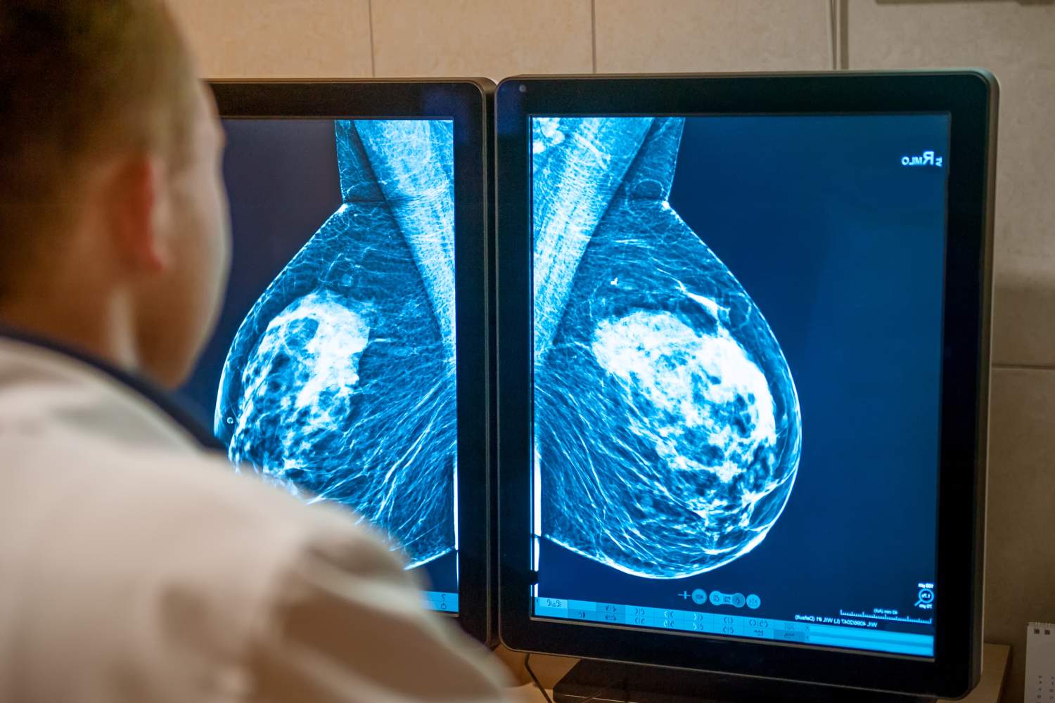 Imagen de una mamografía. Foto: SHUTTERSTOCK. 
