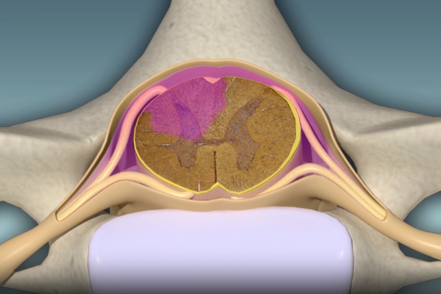 Recreación de cómo las células mesenquimales alcanzan la lesión medular (rosa). Imagen: CLÍNICA MAYO 