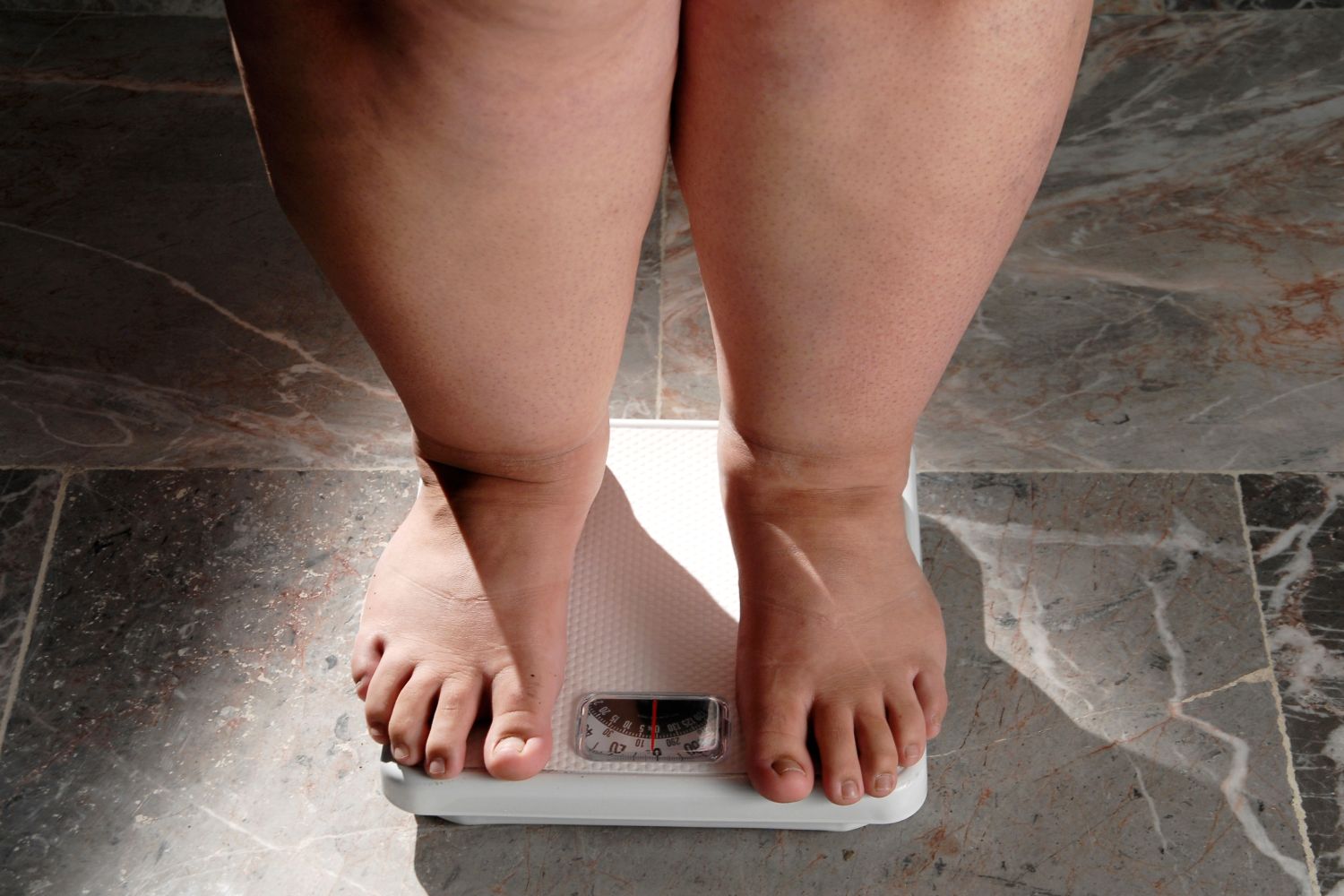 La genética, entre otros factores, ejerce un papel clave en el desarrollo de la obesidad. Foto: SHUTTERSTOCK. 