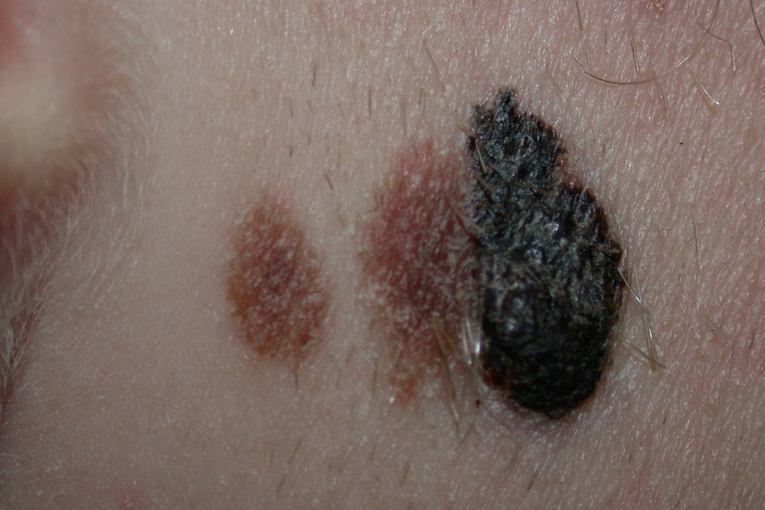 Entre el 2% y el 10% de los supervivientes de un melanoma desarrollarán un segundo melanoma primario. Foto: UE 