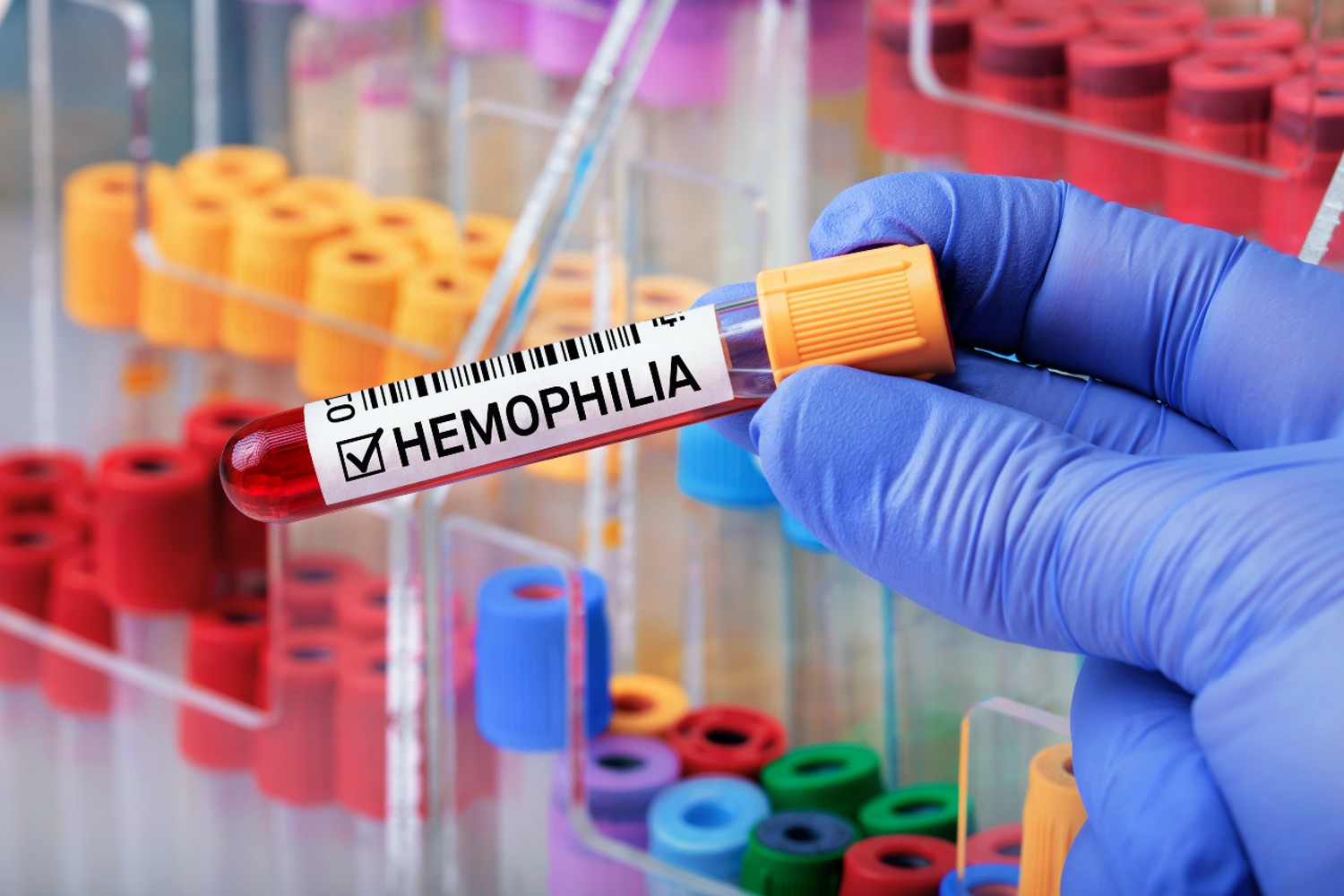 La hemofilia A es una enfermedad genética rara que se da en 1 de cada 5.000 nacimientos masculinos al año. Foto: SHUTTERSTOCK. 